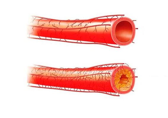 verisuonista johtuvia tehoongelmia